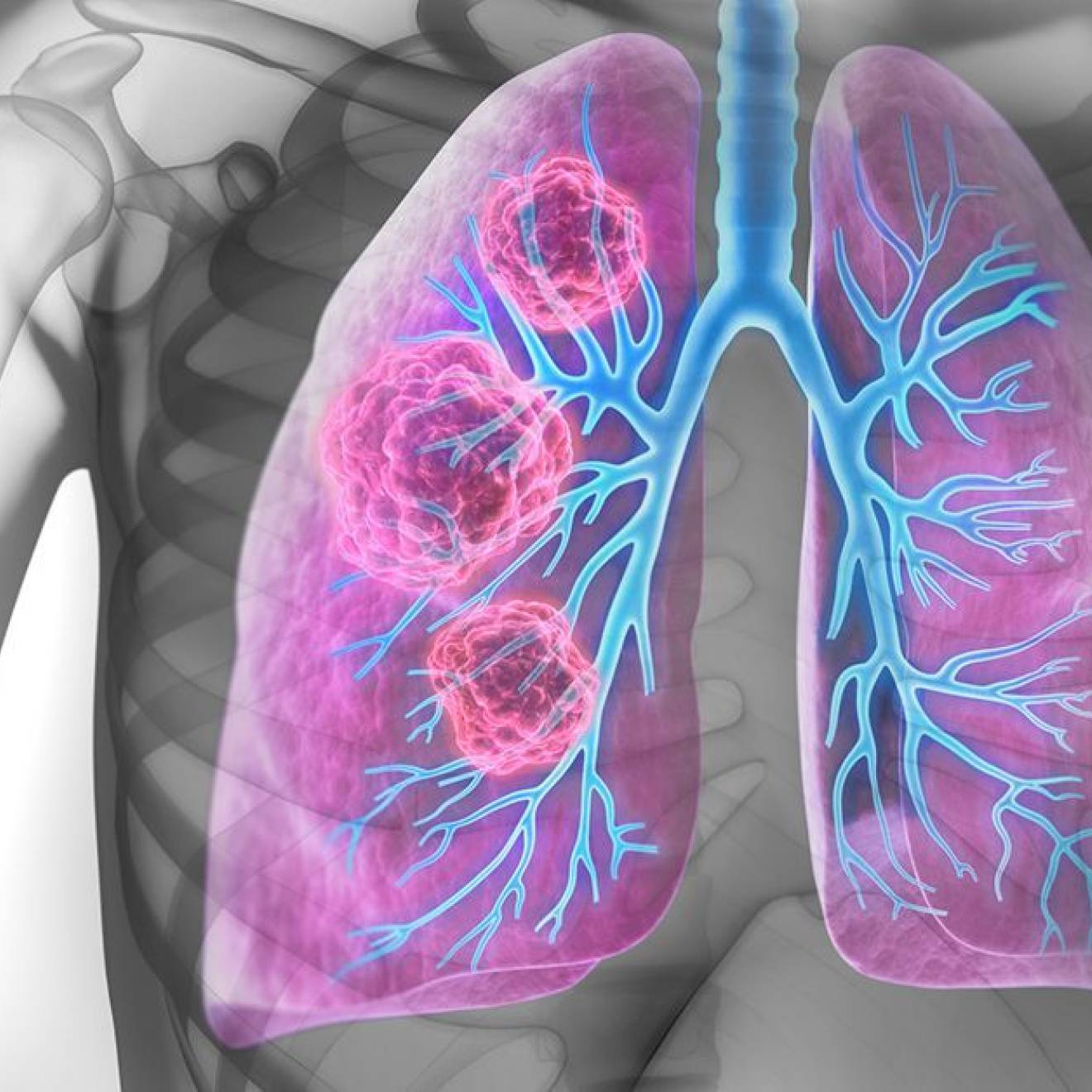 Visualization that looks like an X-ray with pink and blue lungs