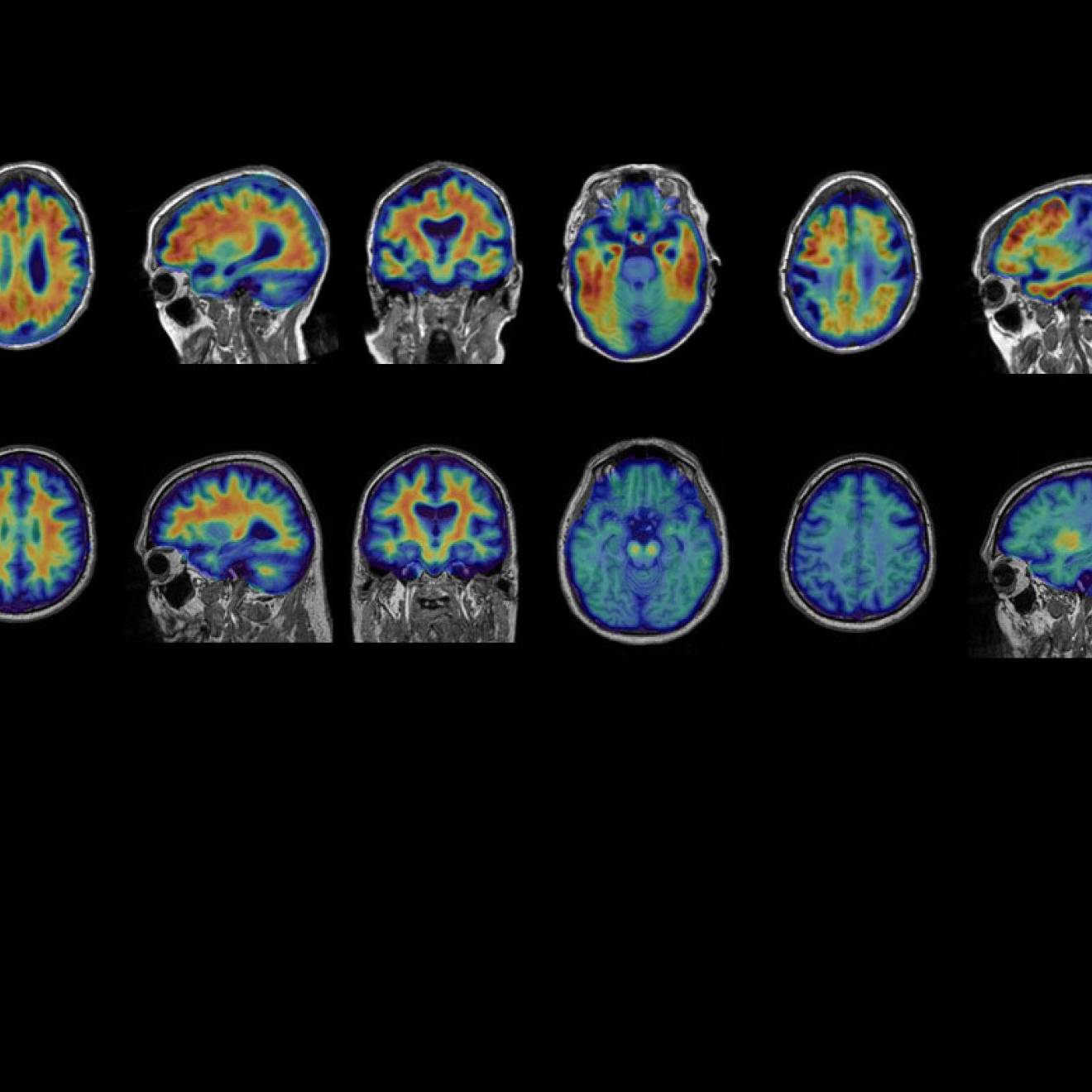 A set of 16 brain PET scans, with orange areas representing Alzheimer's progression