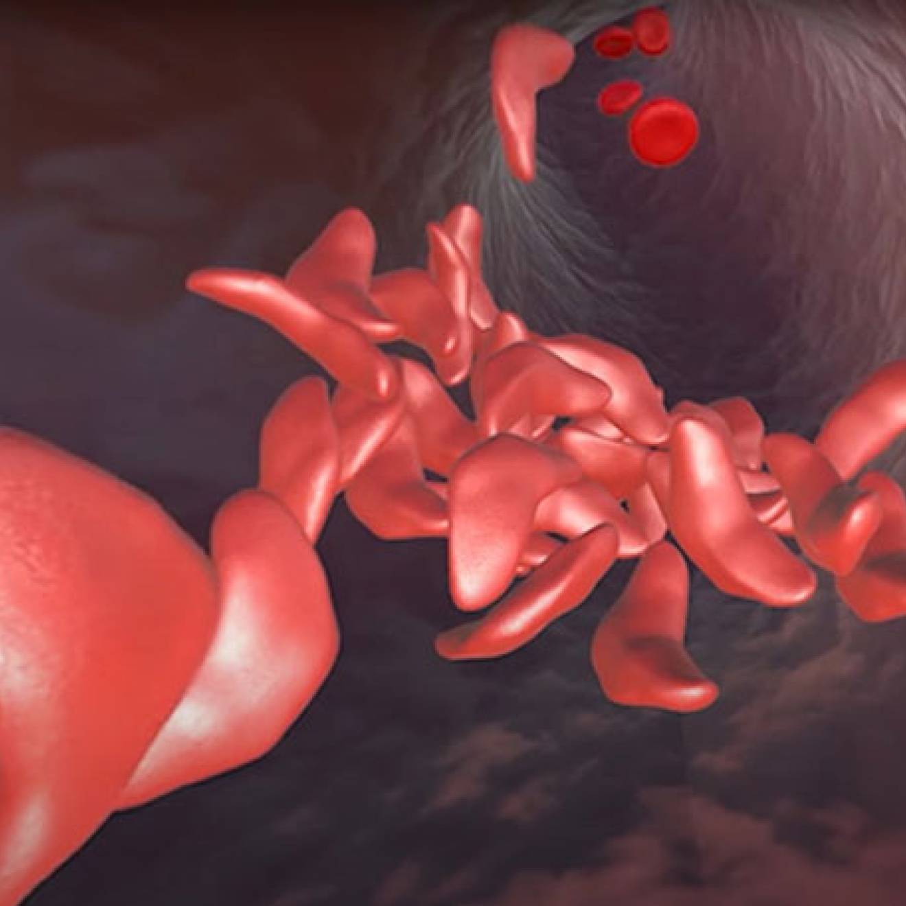 Sickled cells