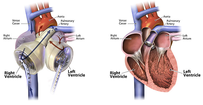 artificial organs